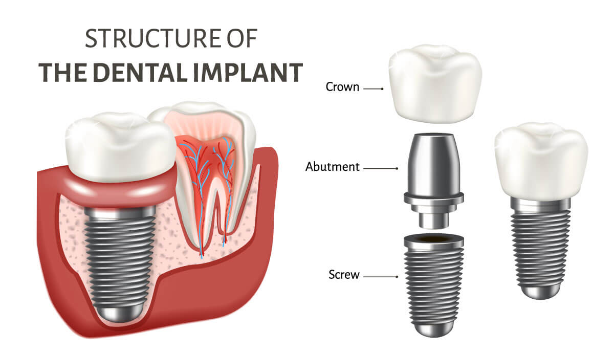poster showing a structure of the dental implant
