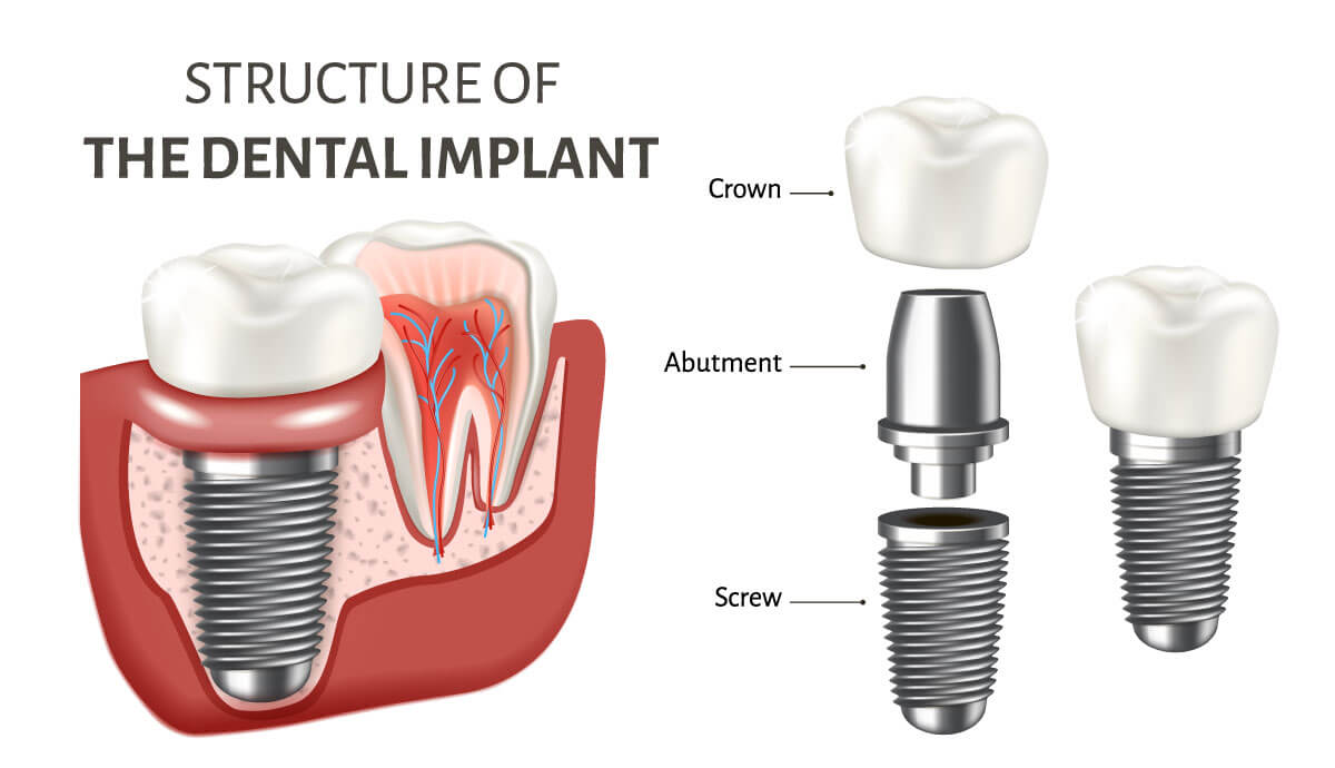 poster showing a structure of the dental implant poster showing a structure of the dental implant