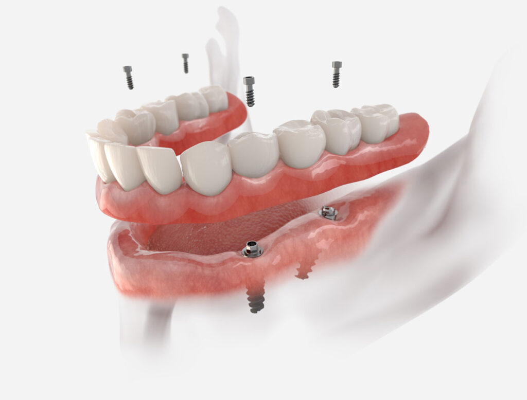 Mandibular fixed restoration