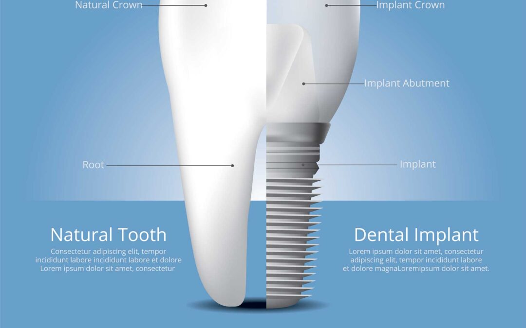 Reasons to Choose Implant-Supported Dentures