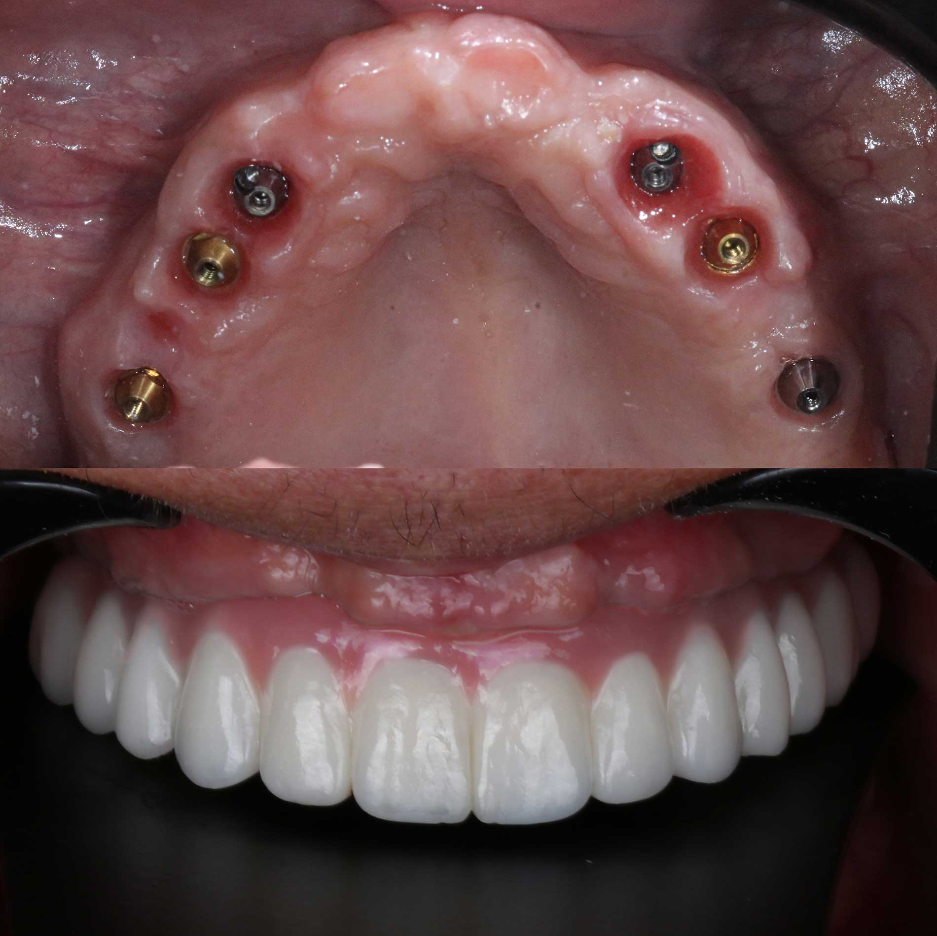 Full-arch-denture-prosthesis-with-dental-implants-placed-in-the-jawbone